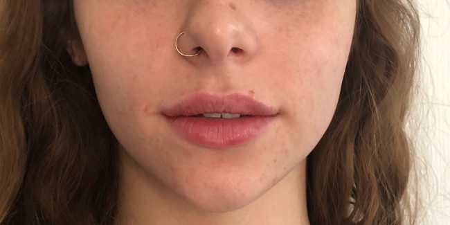 Dermal Filler Before and After - Case 21, Image 2 - Female, age 25 – 34 - Vero Beach, FL - Align Medical Aesthetics
