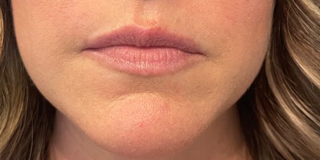 Dermal Filler Before and After - Case 17, Image 1 - Female, age 25 – 34 - Vero Beach, FL - Align Aesthetics & Wellness