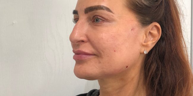 Thread Lift Before and After - Case 4, Image 2 - Female, age 55 – 64 - Vero Beach, FL - Align Aesthetics & Wellness