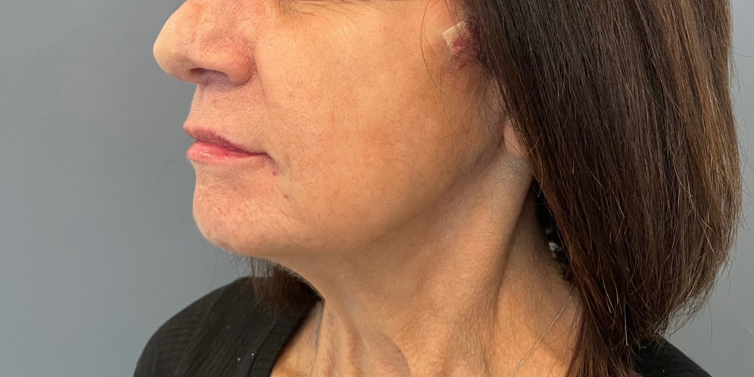 Thread Lift Before & After, Case 3 Female Align Medical Aesthetics