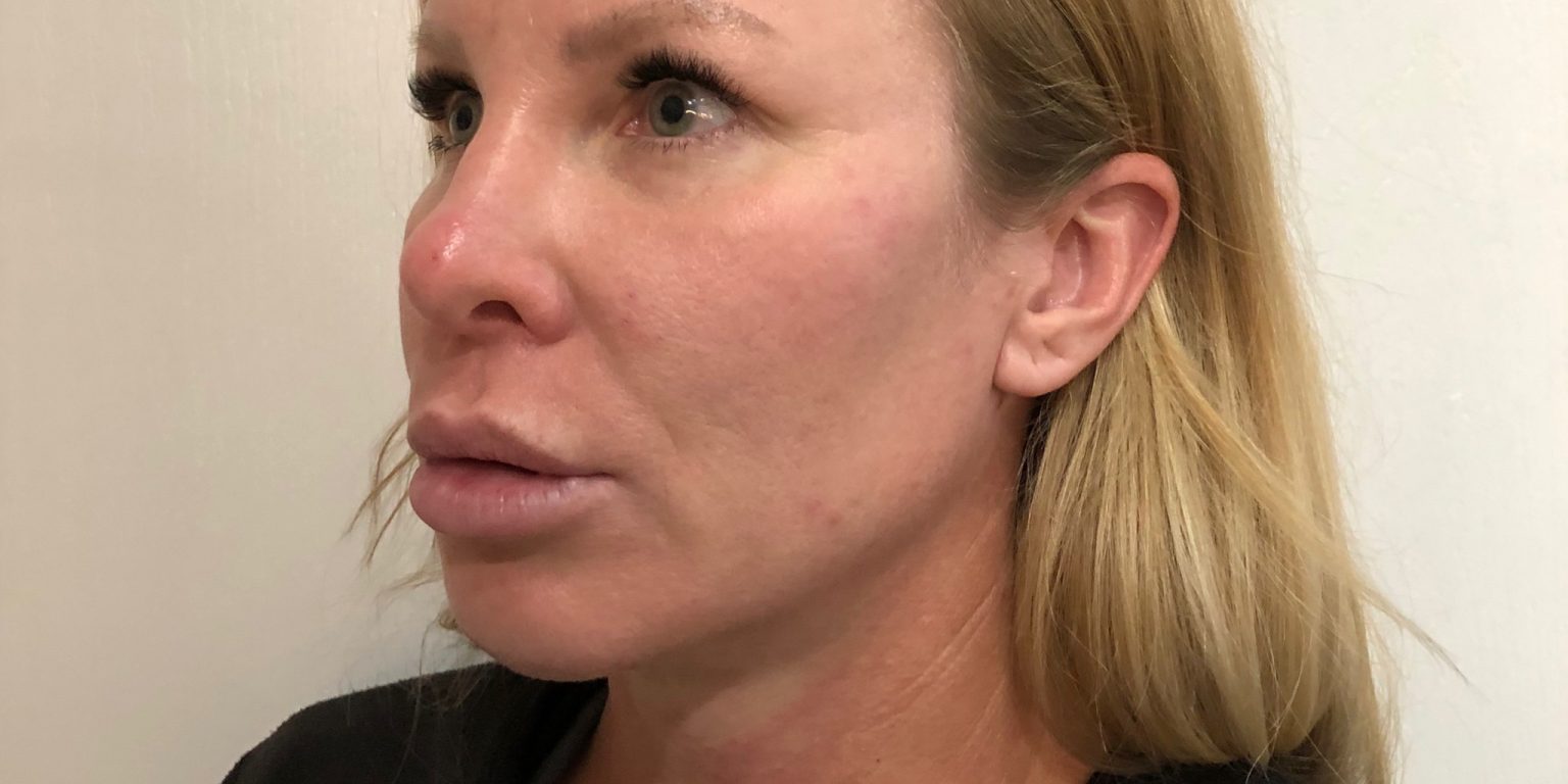 Thread Lift Before & After, Case 5 Female Align Medical Aesthetics